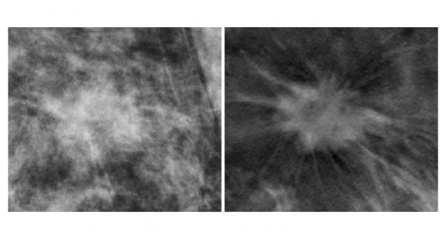 Fig 1 | Example of an Invasive Carcinoma imaged with FFDM (left) and DBT (right). Images from Rafferty et al., 2013.